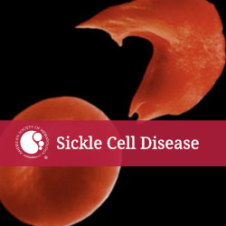 Sickled Cells